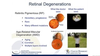 A Stem CellBased Therapy for Retinitis Pigmentosa [upl. by Anned]