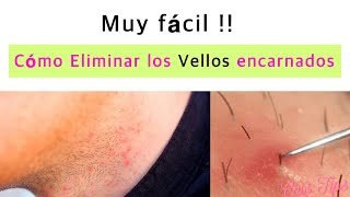 5 Remedios naturales para quitar los vellos encarnados [upl. by Ahsaele480]