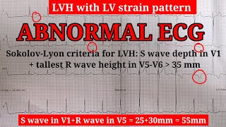 ECG Learn about STRAIN PATTERN  Very important topic [upl. by Nimaynib68]