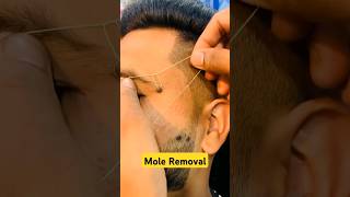 How to remove a mole moles moleremoval shorts drniveditadadu [upl. by Tnilf]