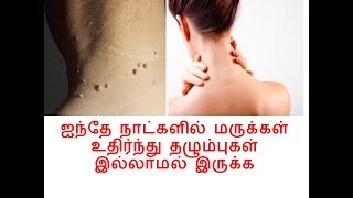 ஐந்து நாட்களில் மருக்கள் உதிர  REMOVE SKIN TAG IN TAMIL LANGUAGE [upl. by Macomber]