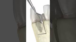 Dental bone graft 3d animation medicalanimation dentalprocedure [upl. by Monaco]