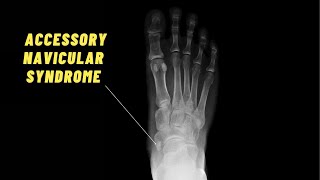 BEST Exercises for Accessory Navicular Syndrome [upl. by Annais]