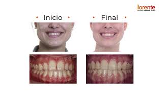 Caso clínico Clase III Dentaria  Lorente Ortodoncia ortodoncia [upl. by Akehs]