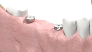 SIC invent Dental Implant  Prosthetic Animation BridgeWork Open Tray Technique [upl. by Na]