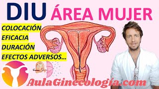 DIU DE COBRE COLOCACIÓN EFICACIA DURACIÓN EFECTOS ADVERSOS RIESGOS Ginecología y Obstetricia [upl. by Ganiats]