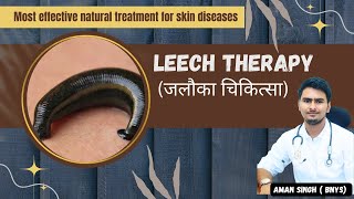 Leech therapy  Most effective natural treatment  in Naturopathy amp Ayurveda [upl. by Macnair918]