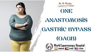 One Anastomosis Gastric Bypass OAGB [upl. by Craner205]