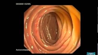 Hereditary Hemorrhagic Telangiectasia OslerWeberRendu Disease [upl. by Alleuol422]