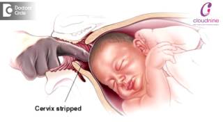 Methods of Labour Induction  Dr Padmini Isaac  Cloudnine Hospitals [upl. by Aissila602]