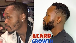 HOW I GREW MY BEARD USING MINOXIDIL  GET RID OF PATCHY BEARD [upl. by Alekal18]