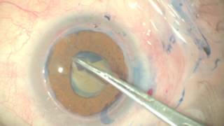 The Triple Procedure  Combined Penetrating Keratoplasty and Cataract Extraction [upl. by Dickerson]