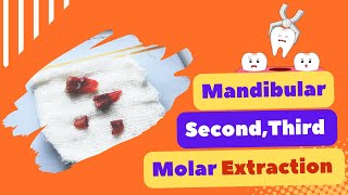 Mandibular Second and Third Molar Tooth Extraction dentist dentistry [upl. by Leiahtan]