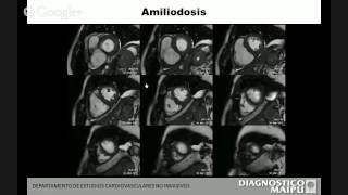 RMN CARDIACA Dr Alejandro Deviggiano [upl. by Buyers]