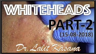 ANTI ACNE TREATMENT PART2 BY DRLALIT KASANA15082018 [upl. by Oiratnom]