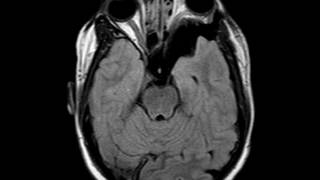 Sphenoid Wing Dysplasia [upl. by Neelhsa848]