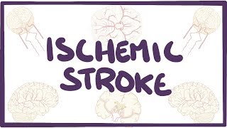 Ischemic Stroke  causes symptoms diagnosis treatment pathology [upl. by Sou581]