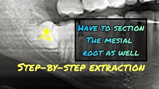 When the Mesial Root is Stuck Step by Step Wisdom Tooth Extraction Video with Instruments Listed [upl. by Telfer]