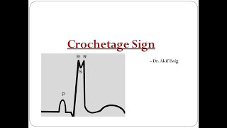 Crochetage sign in ASD  Dr Akif Baig [upl. by Onitsuj]