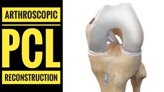 Arthroscopic PCL Posterior Cruciate LigamentReconstruction with Hamstring Graft [upl. by Eissen503]