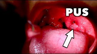 GIANT TONSILS WITH WHITE PUS Strep Throat  Mono  Dr Paul [upl. by Marni636]