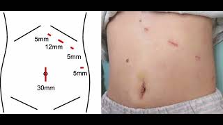 Hereditary spherocytosis mrcpch Clinical [upl. by Aralomo452]