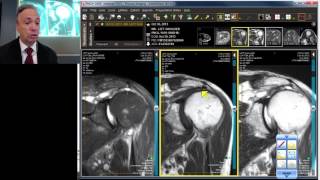 MRI Case Review Shoulder Deep Dive [upl. by Ling322]