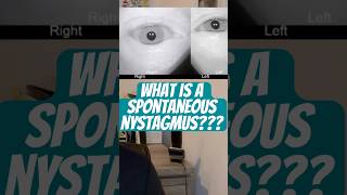 Spontaneous nystagmus  IS this causing YOUR Dizziness vestibular [upl. by Gamali478]