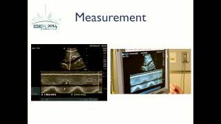 Inferior Vena Cava Ultrasound [upl. by Shultz]