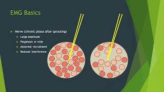 Neuropathy vs myopathy on EMG [upl. by Hctub125]