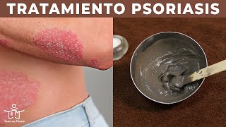 PSORIASIS en la PIEL ⚡  El MEJOR TRATAMIENTO en 3 PASOS 💧 [upl. by Three]