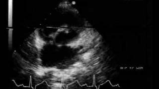 echocardiogramcoronary left ventricular fistula short axis view [upl. by Derwin]