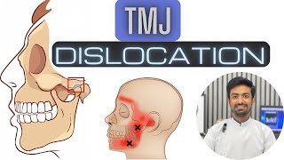 TMJ Dislocation and Management [upl. by Aryamo]