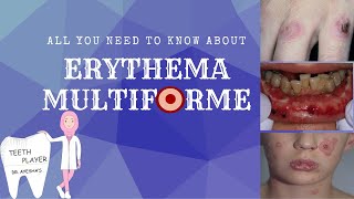 ERYTHEMA MULTIFORME CLINICAL PRESENTATIONTYPESDIAGNOSISTREATMENT ANIMATED ORAL PATHOLOGY NOTES [upl. by Elitnahc]