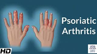 Psoriatic Arthritis Causes Signs and Symptoms Diagnosis and Treatment [upl. by Kingdon]