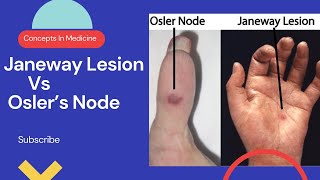 Janeway Lesions Vs Oslers Nodes Simplified Approach [upl. by Morganica844]