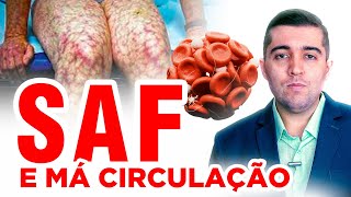 Síndrome do Anticorpo Antifosfolipídeo SAF como proteger veias evitar má circulação e trombose [upl. by Rachaba]