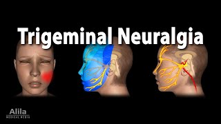 Trigeminal Neuralgia Tic Douloureux Animation [upl. by Remsen]