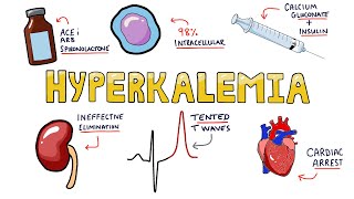 An Approach to Hyperkalemia  ECG changes in Hyperkalemia  What are the causes of Hyperkalemia [upl. by Einnil]