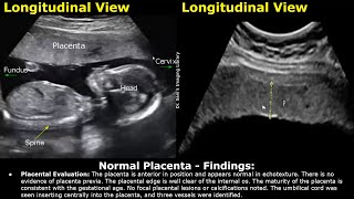 Placenta Ultrasound Reporting  How To Write Pregnancy USG Reports  Pathologies amp Positions Scans [upl. by Uticas]