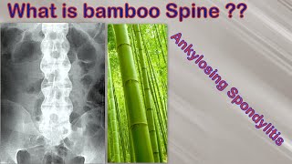 Bamboo Spine in Ankylosing Spondylitis AS [upl. by Anirtek]