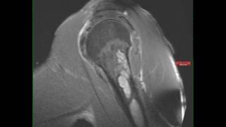 Polyostotic Fibrous Dysplasia [upl. by Ahtnama]