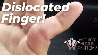 WATCH Relocating My Patients Finger [upl. by Nrubyar]