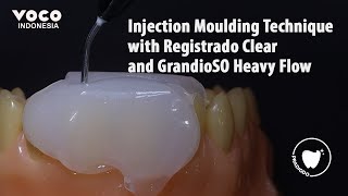 Injection Molding Technique with Registrado Clear amp GrandioSO Heavy Flow  Operative Dentistry VOCO [upl. by Worsham]