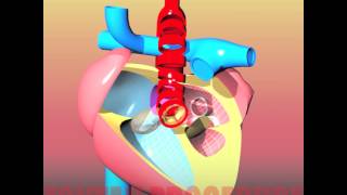 Congenital heart defects III HLHS  Hypoplastic Left Heart Syndrome [upl. by Daniel]