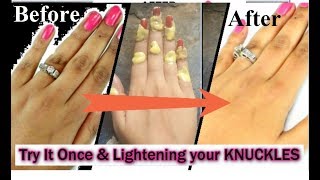 उंगलियों के जोड़ों की काली त्वचा से छूटकारा पाए  Lightening your KNUCKLES  Finger Joints [upl. by Dermot]