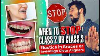 When to STOP Invisalign or Braces Class 2 or Class 3 Elastics [upl. by Nodlehs]