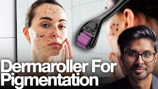 Microneedling For Pigmentation SAFE At Home Technique [upl. by Pearla]