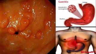 Elimina La Gastritis Para Siempre Con Este Eficaz Remedio [upl. by Chung]