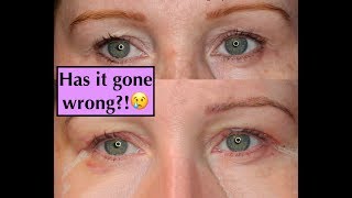 Blepharoplasty Experience UK Eyelid SurgeryHooded Eyes  1 WkStitches Removed [upl. by Nannahs]